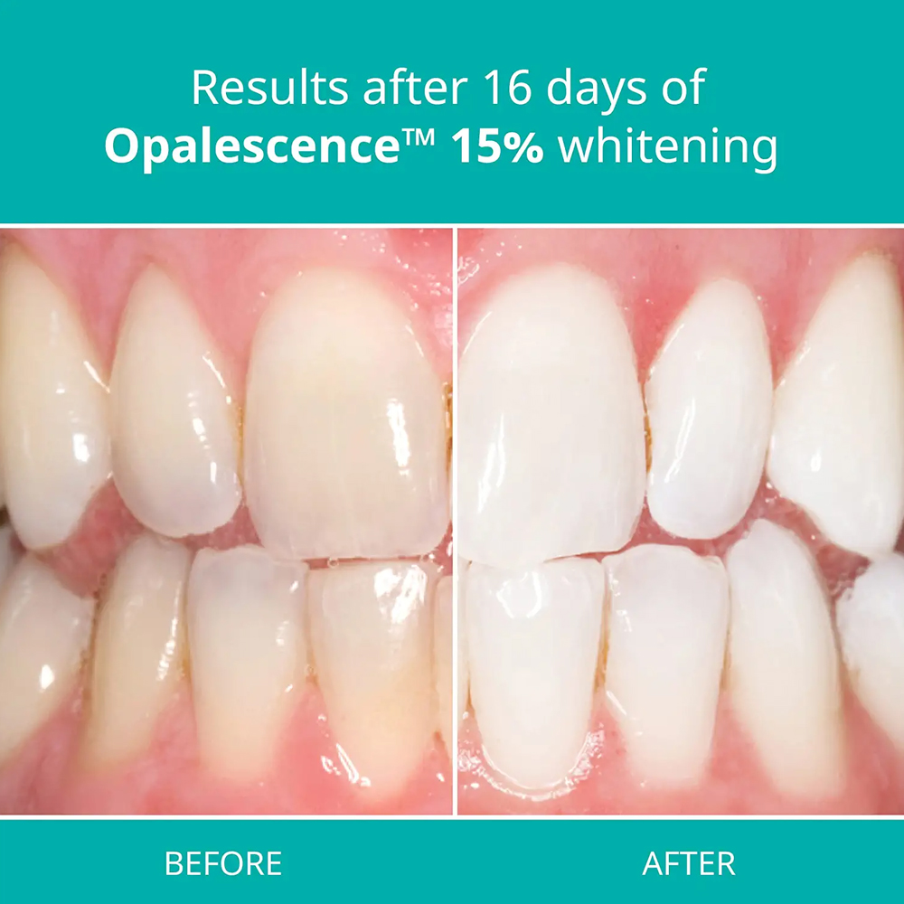 Opalescence Professional White - огляд і ціна Teeth Whitening Gel Refills