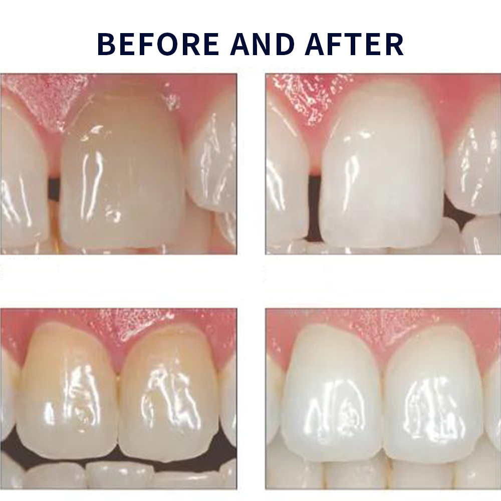 Opalescence Whitening 20% PF 2 - огляд і ціна Teeth Whitening Before And After