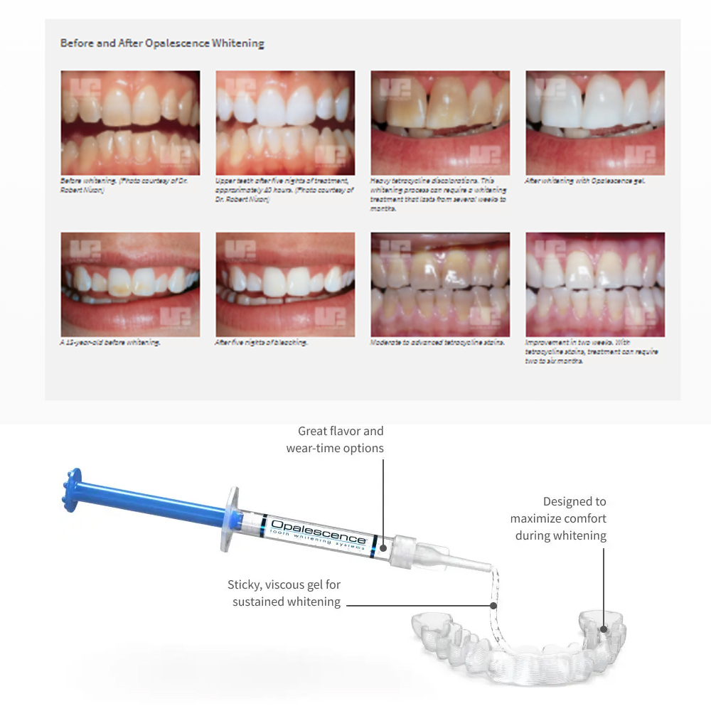 Opalescence Whitening 20% PF 2 - огляд і ціна Teeth Whitening Before And After
