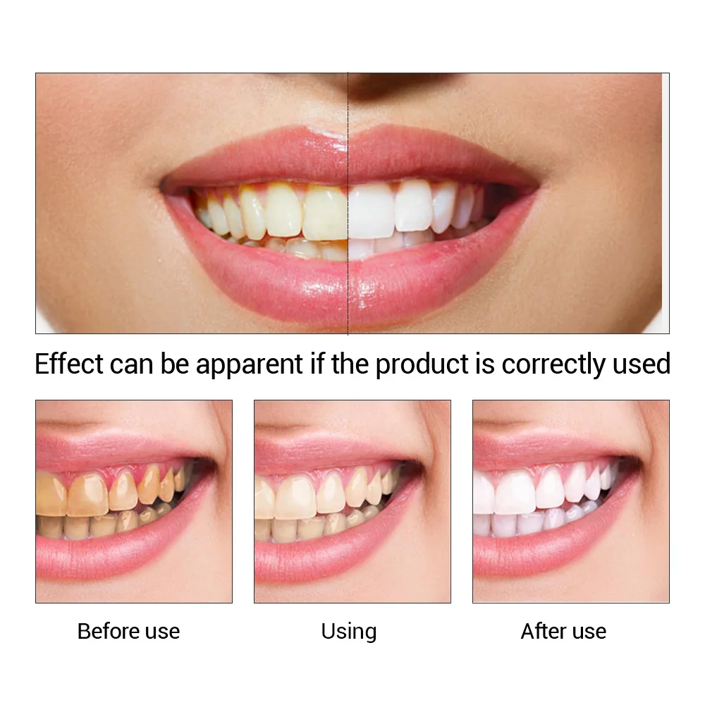 FTEENPLY Teeth Whitening Essen - огляд і ціна Teeth Whitening Hismile