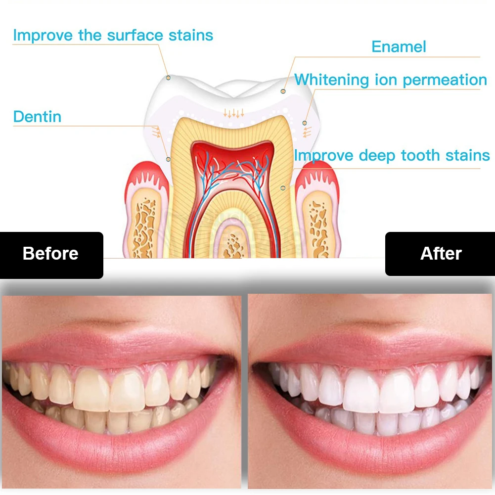 Dental Teeth Whitening Kit Min - огляд і ціна Teeth Whitening With Blue Light
