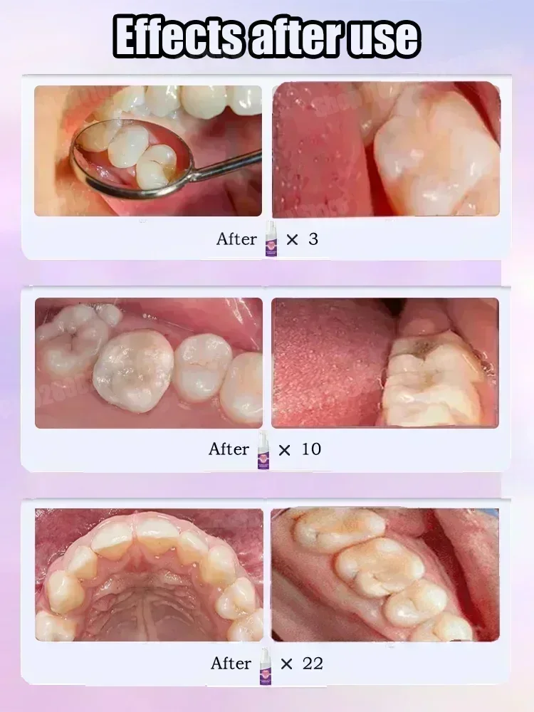 Teeth Cleaning Toothpaste Remo - огляд і ціна Teeth Whitening That Works