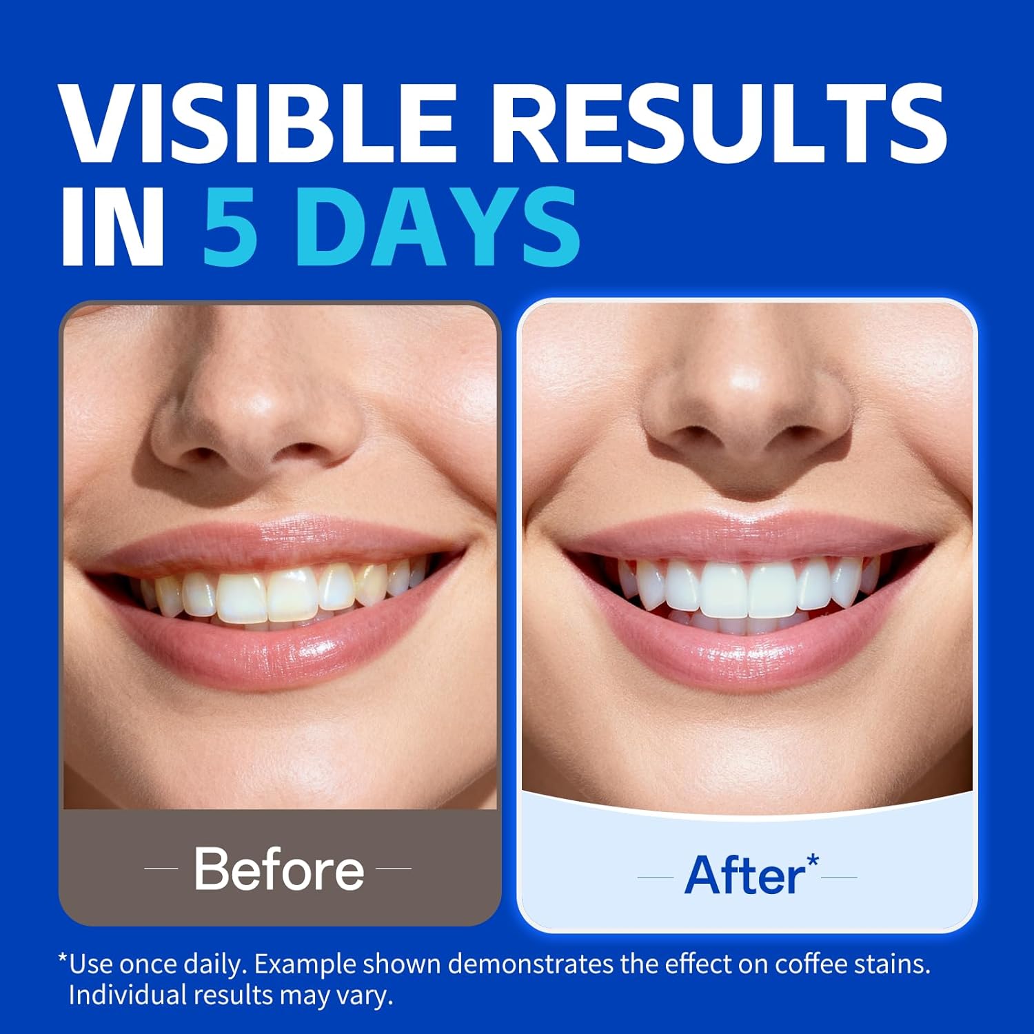 KHAZIX Teeth Whitening Strips  - огляд і ціна Teeth Whitening Oil Pulling